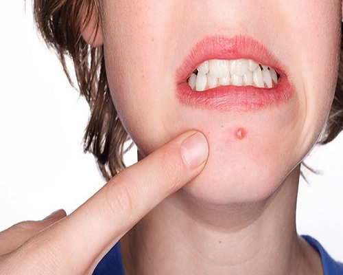 tác dụng trị mụn nhọt tác dụng trị mụn nhọt